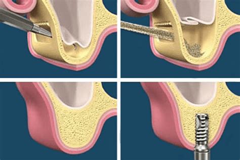 Sinus Lift: Procedure, Cost, Recovery, and More .